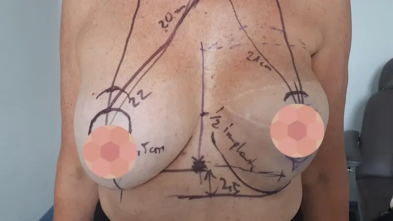 PG asymetria 3 przed