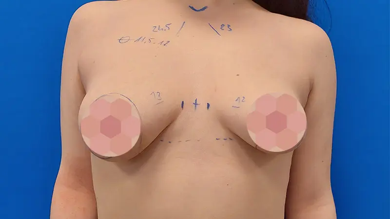 PG asymetria 5 przed