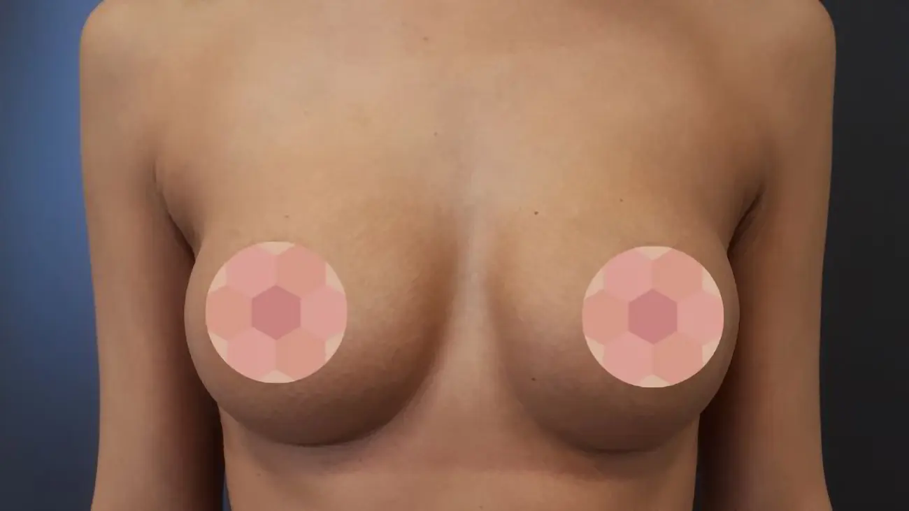 PG augmentacja 17 po resize