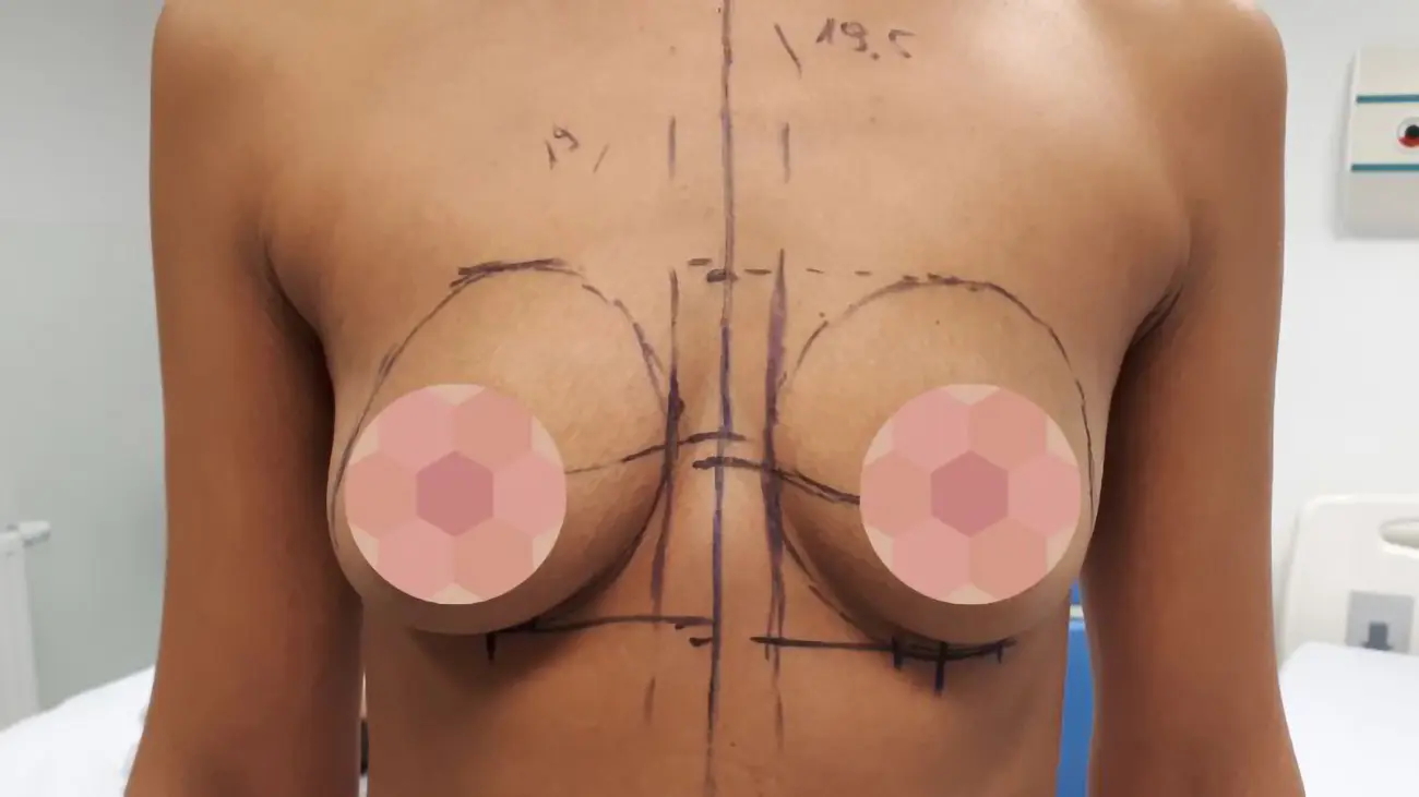 PG augmentacja 17 przed resize