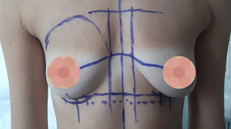 PG augmentacja 0001 6 przed