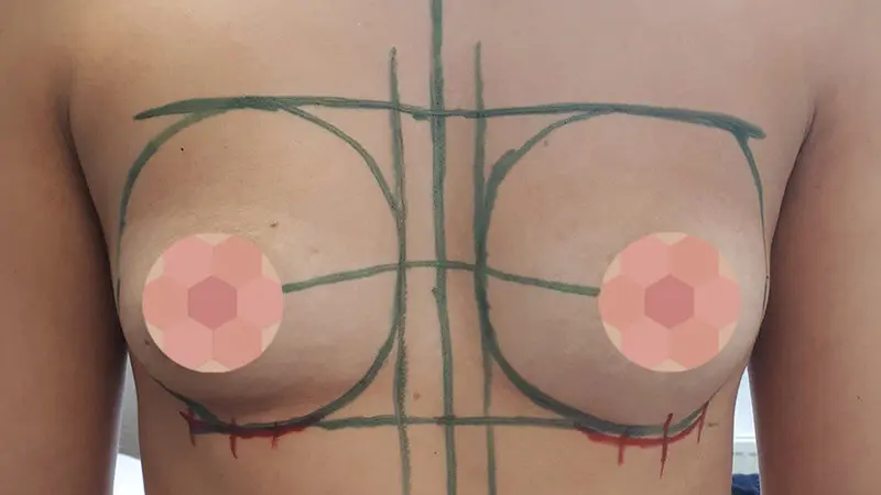 PG augmentacja 0003 18 przed