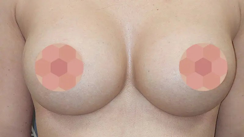 PG augmentacja 0008 24 po