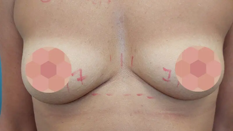 PG augmentacja 0009 24 przed