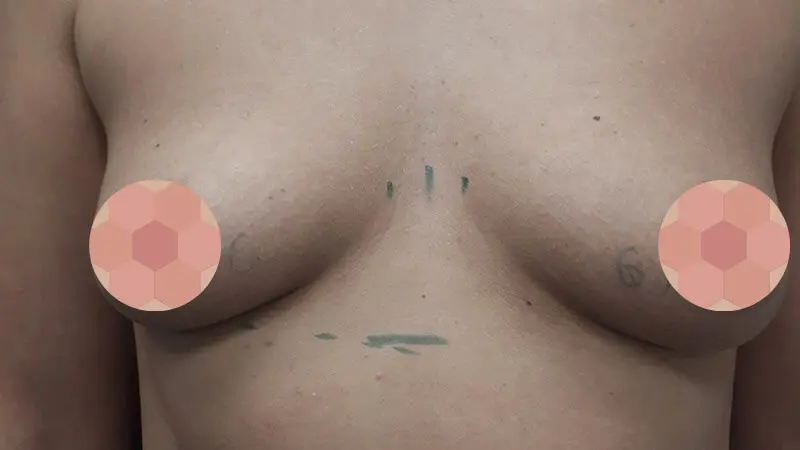 PG augmentacja 0013 22 przed