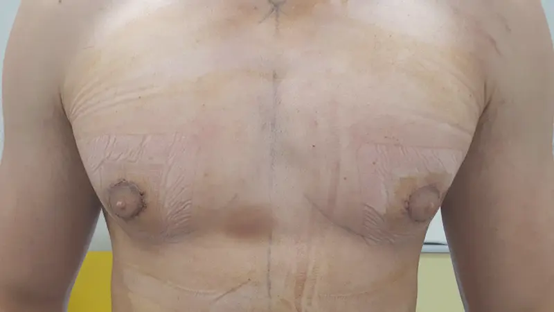 PG ginekomastia 1 po