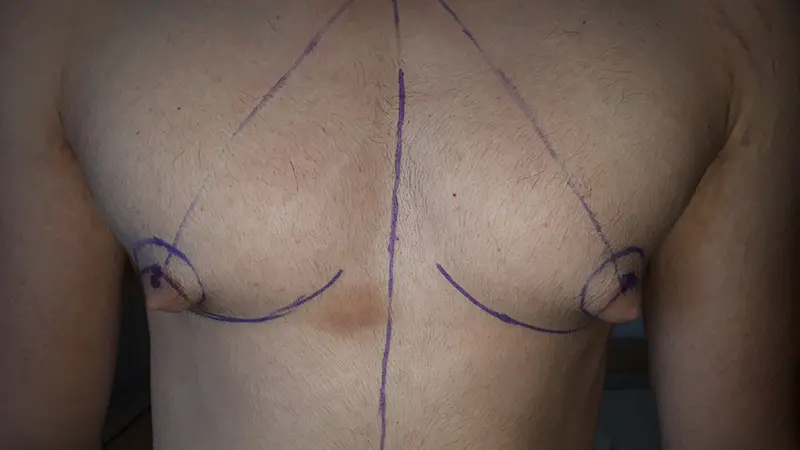 PG ginekomastia 1 przed