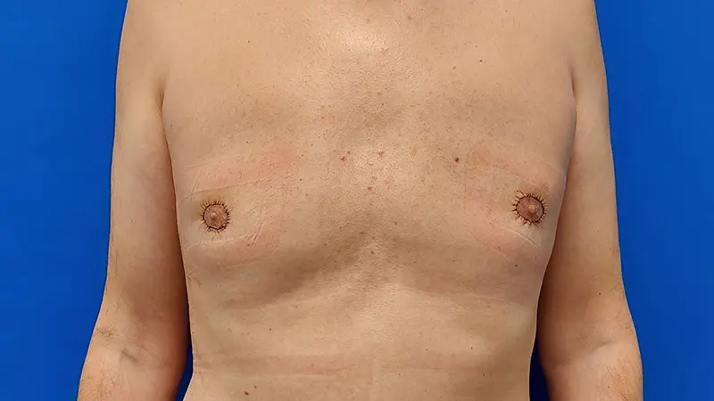 PG ginekomastia 2 po