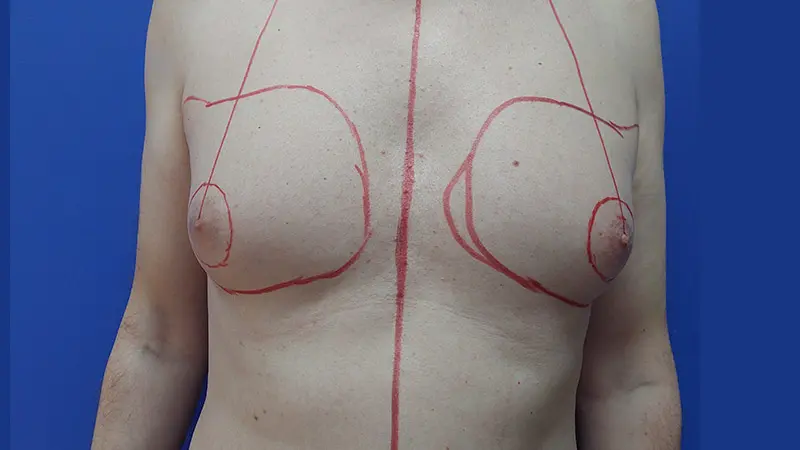 PG ginekomastia 2 przed