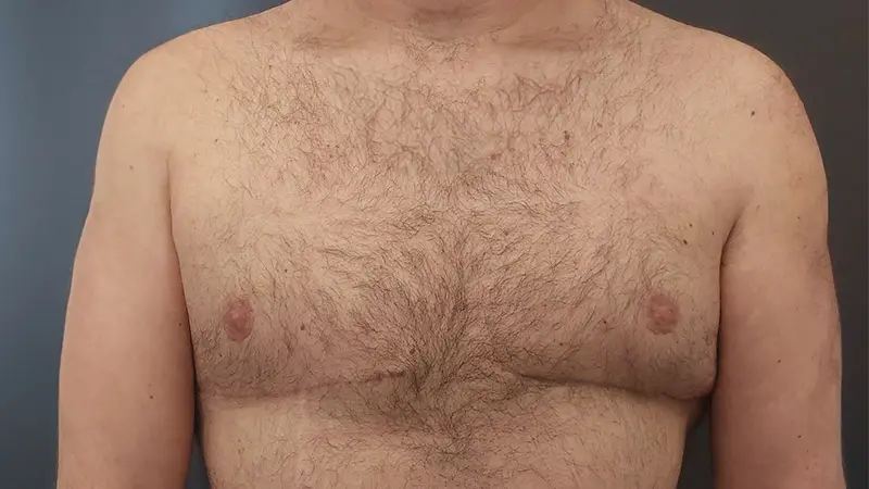 PG ginekomastia 3 po