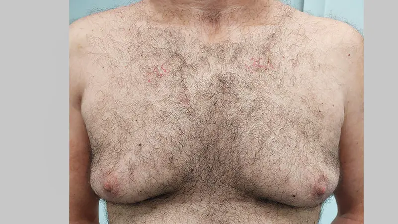 PG ginekomastia 3 przed