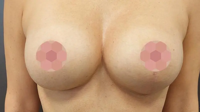 Asymetria piersi 9 po