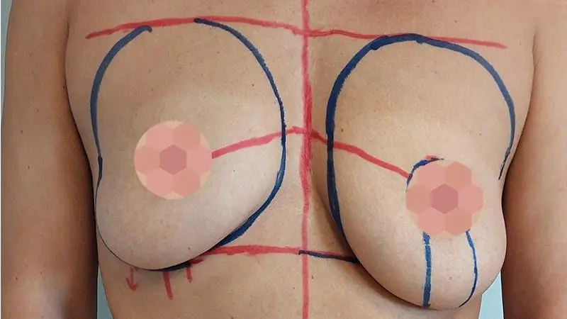 Asymetria piersi 9 przed