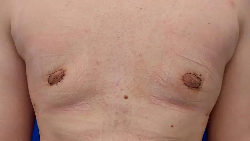 Ginekomastia 4 po liposukcja wyciecie gruczolu z ciecia okolootoczkowego