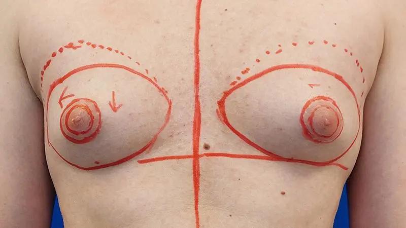 Ginekomastia 4 przed liposukcja wyciecie gruczolu z ciecia okolootoczkowego