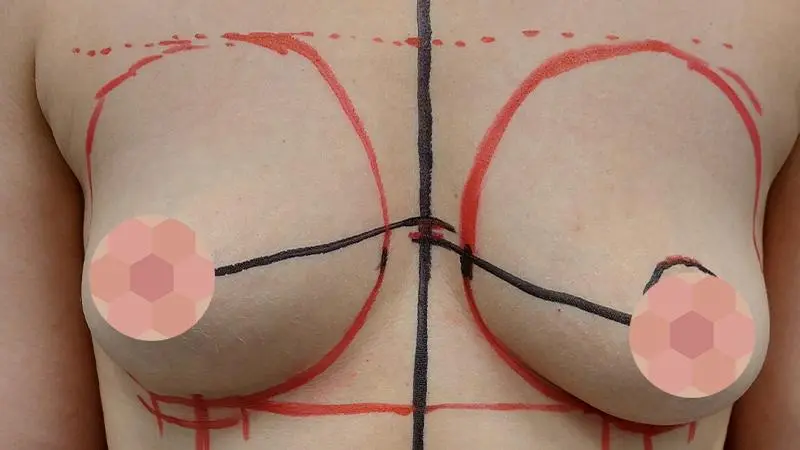 Implanty 30 przed Mentor piers prawa TMPX 405cc piers lewa TMPX 370cc piers lewa z niewielka mastopeksja o