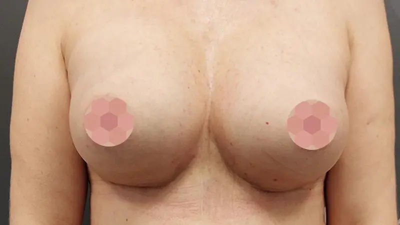 Implanty 32 po Mentor okragle 350cc