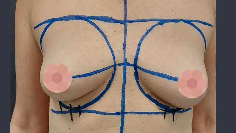 Implanty 32 przed Mentor okragle 350cc