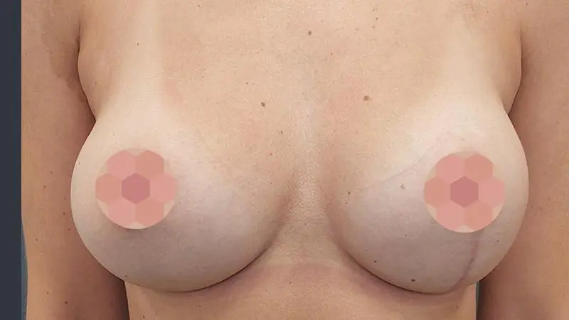 Implanty z mastopeksja 10 po Mentor TMPX 215cc mastopeksja okolootoczkowa piersi prawej z cieciem pionowym po