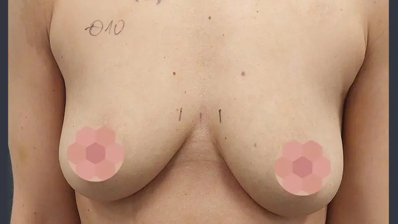 Implanty z mastopeksja 10 przed Mentor TMPX 215cc mastopeksja okolootoczkowa piersi prawej z cieciem pionowym