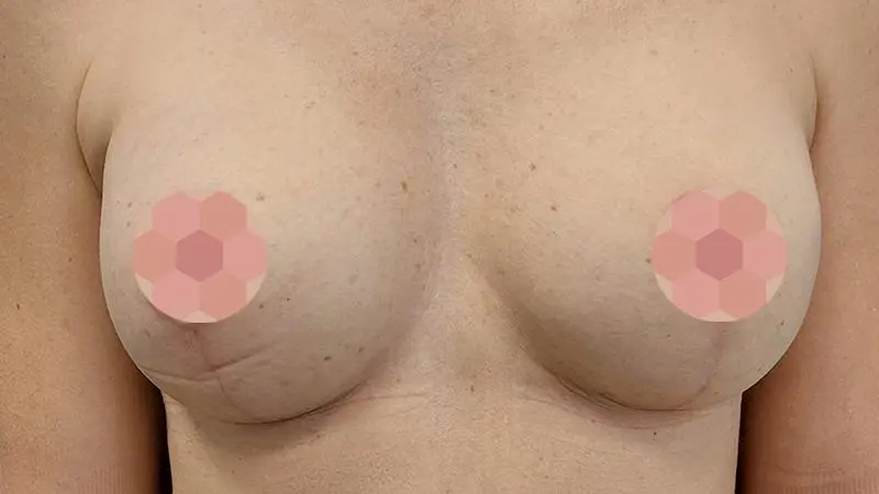 Implanty z mastopeksja 8 po Mentor TMPX 270cc piers prawa TMPX 240cc piers lewa