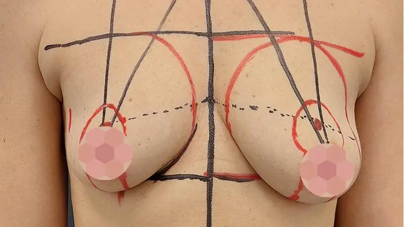 Implanty z mastopeksja 8 przed Mentor TMPX 270cc piers prawa TMPX 240cc piers lewa