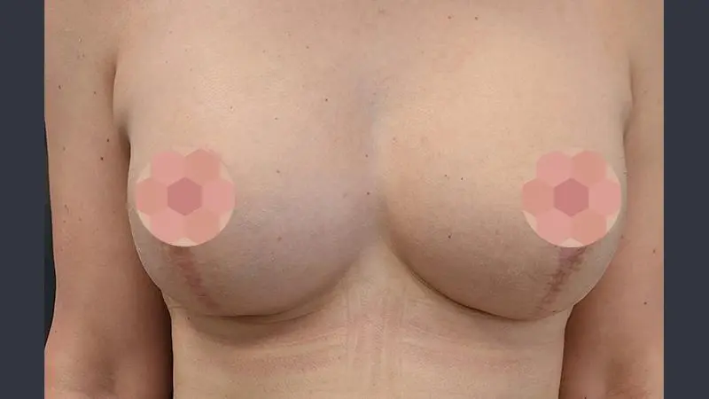 Implanty z mastopeksja 9 po Mentor TMPX 350cc