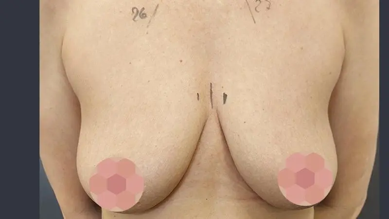 Implanty z mastopeksja 9 przed Mentor TMPX 350cc