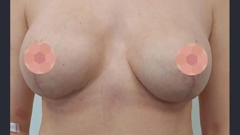 Mastektomia podskorna redukcyjna 1 obustronna z rownoczasowa rekonstrukcja protezami po