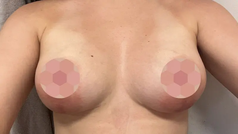 Masto z implantami 2 po