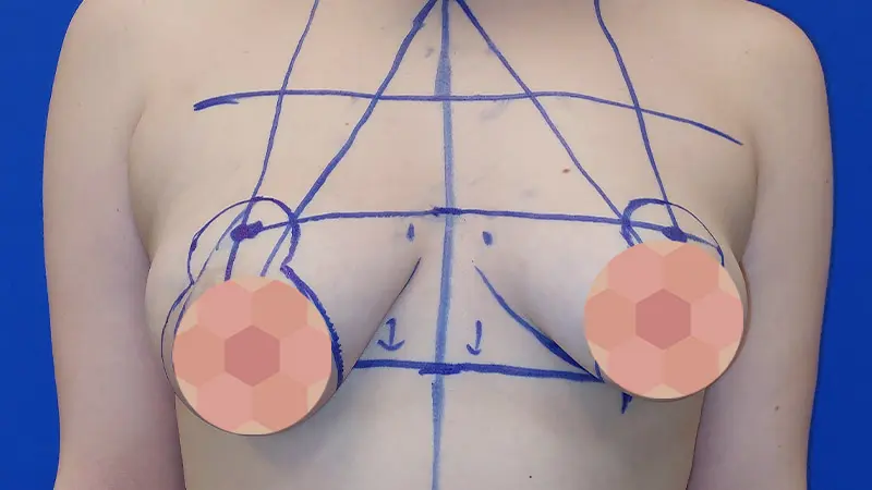 Masto z implantami 2 przed