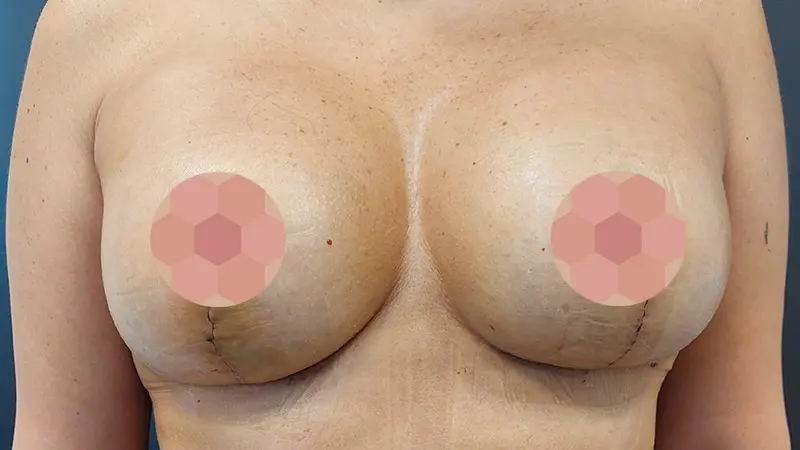 Masto z implantami 6 po