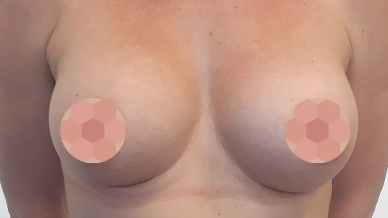 Mastokolootoczkowe po