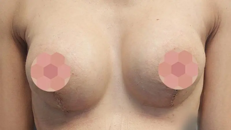 Mastopeksja z implantami po przod po czyszczeniu piersi z Aquafillingu