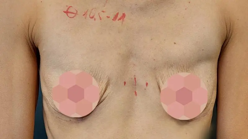 Mastopeksja z implantami przed przod po czyszczeniu piersi z Aquafillingu
