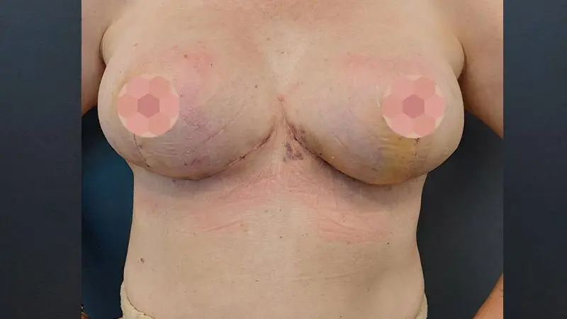 Redukcja 10 po przod