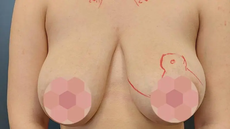 Redukcja 11 przed przod