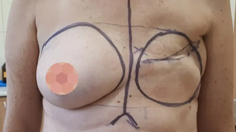 Rekonstrukcja gierej 0010 DIEP 3 przed